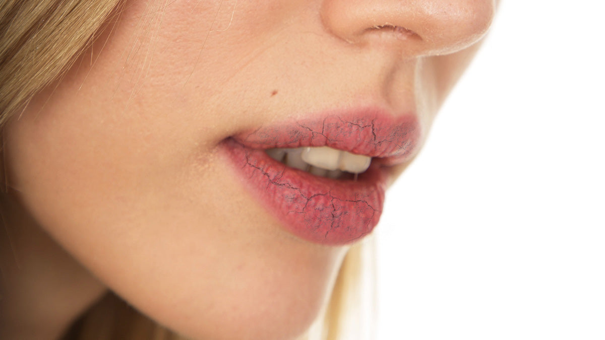 How to Soften Chapped Lips Naturally – BargzNY